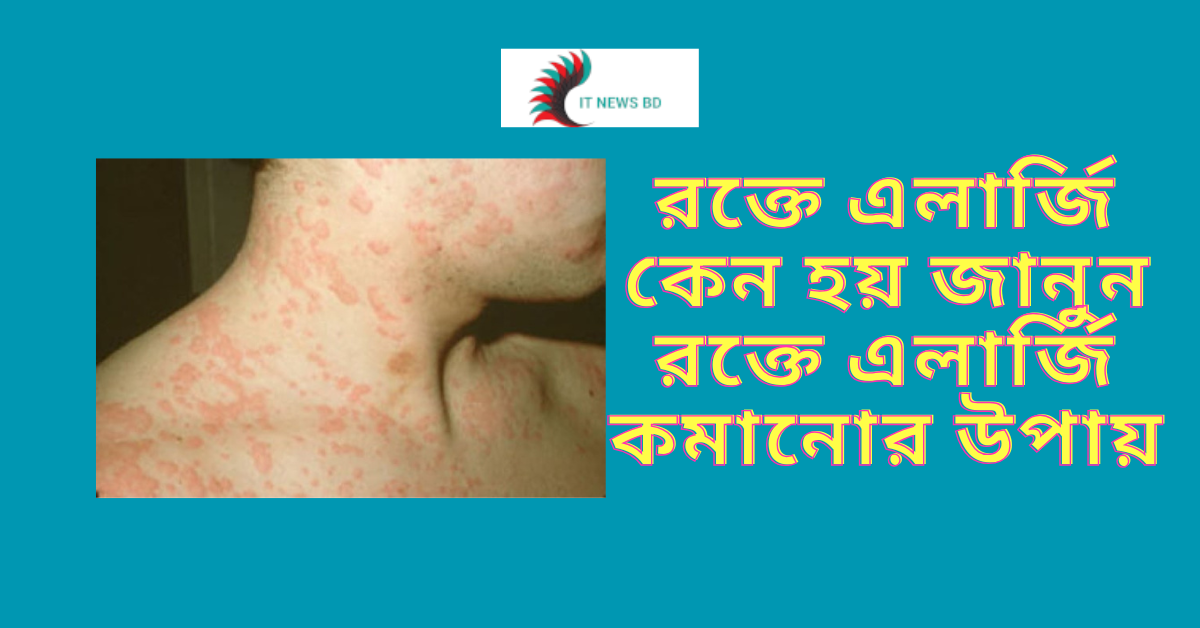 এলার্জি প্রতিরোধ