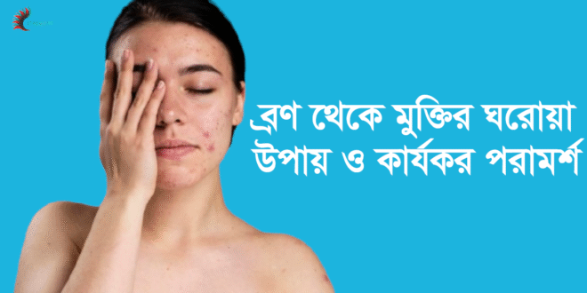 ব্রণ থেকে মুক্তির উপায়: কার্যকরী ও প্রাকৃতিক সমাধান